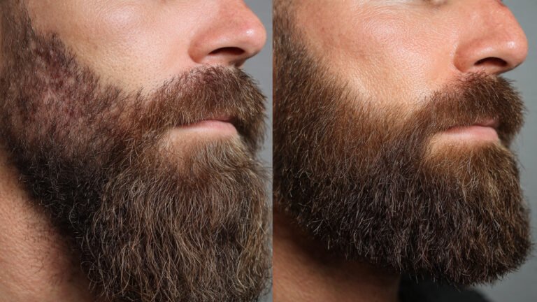 Beard Clean Up Before and After Transformation